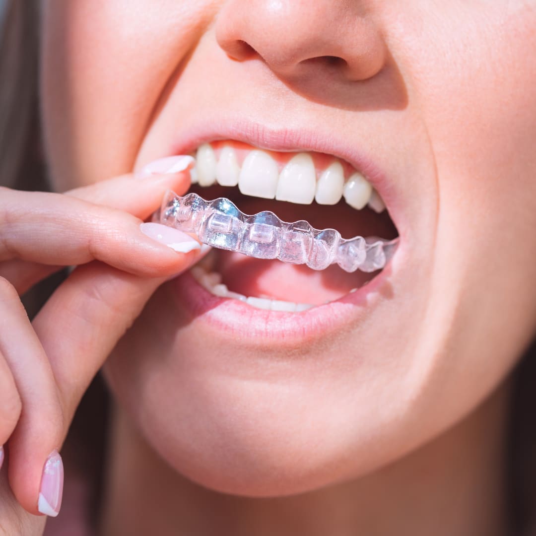 Invisalign dentist