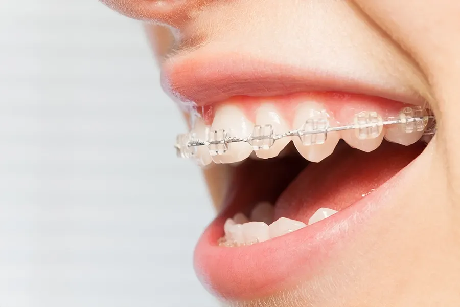 Ceramic clear braces close up
