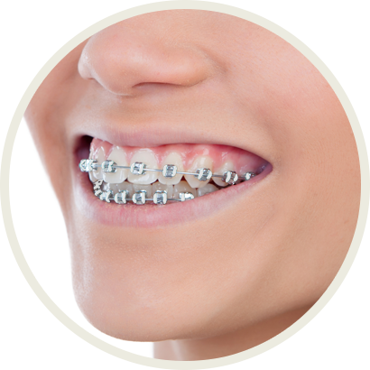 Braces color options