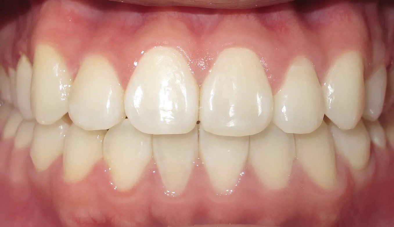 Afterteeth2. Jpg