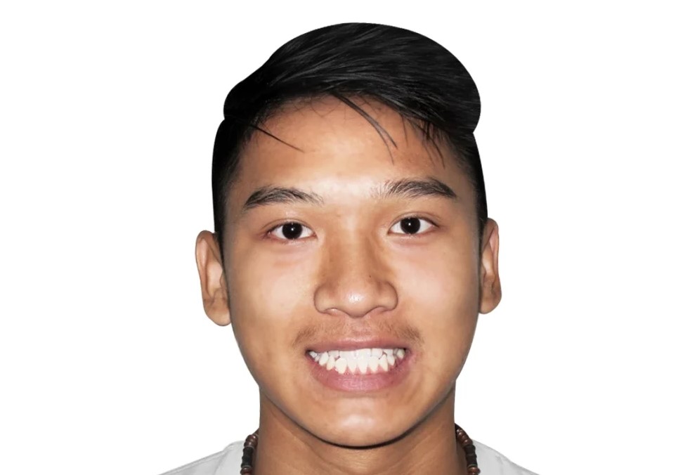 Beforesmile2. Jpg