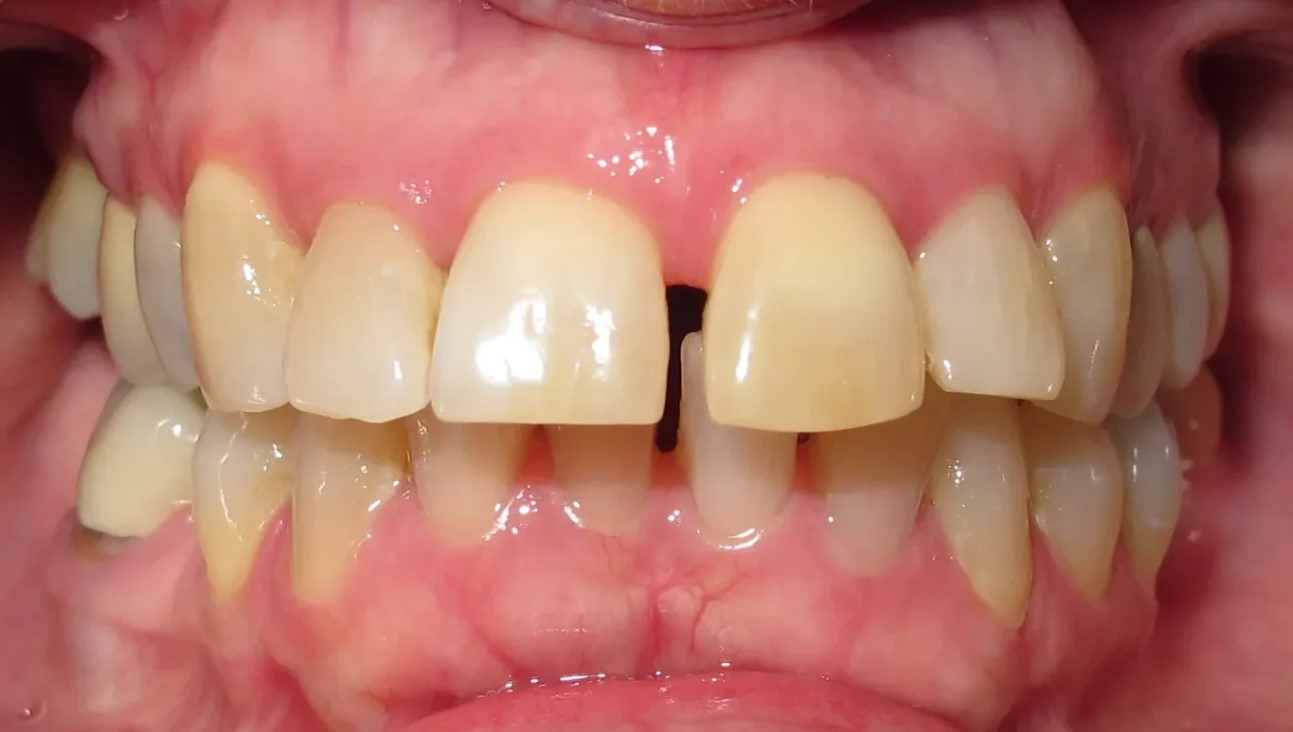 Beforeteeth3. Jpg